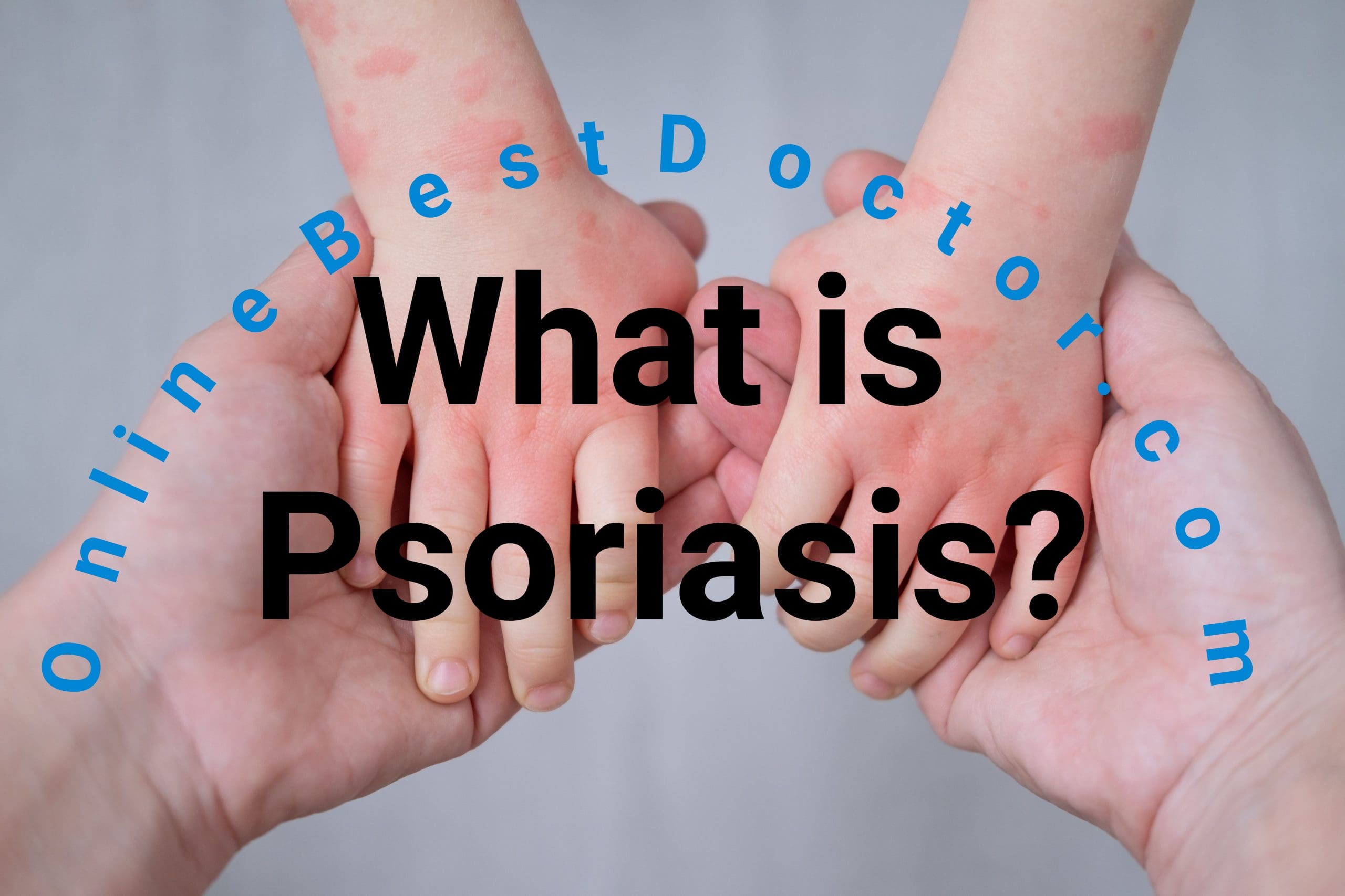 Main Cause of Psoriasis